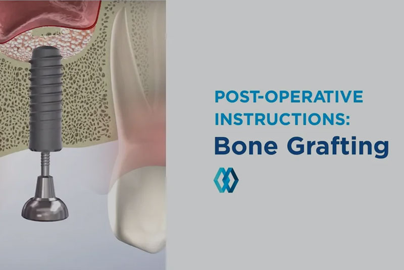 postoperative bone grafting instructive graphic