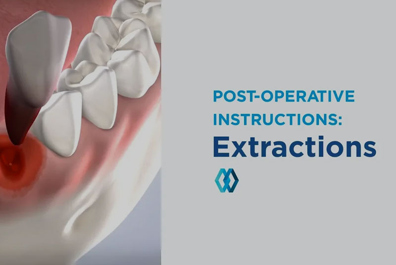post operative extractions instructive graphic
